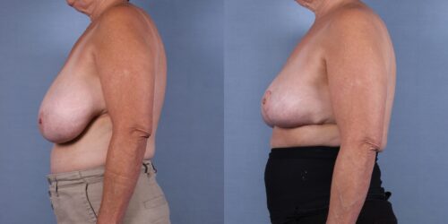 Female Breast Reduction Case #75739 (Image 3)