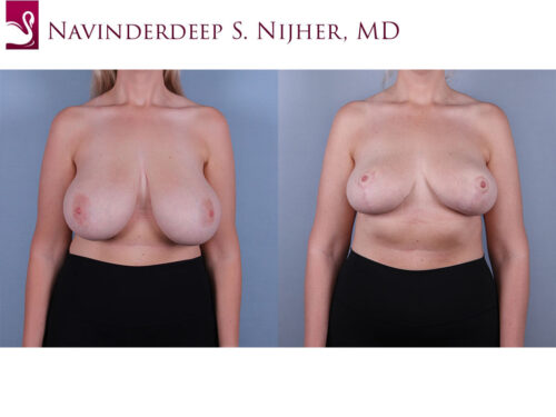 Female Breast Reduction Case #74755 (Image 1)