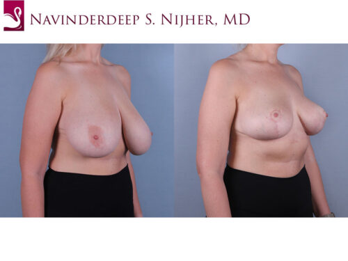 Female Breast Reduction Case #74755 (Image 2)