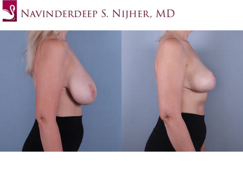 Female Breast Reduction Case #74755 (Image 3)