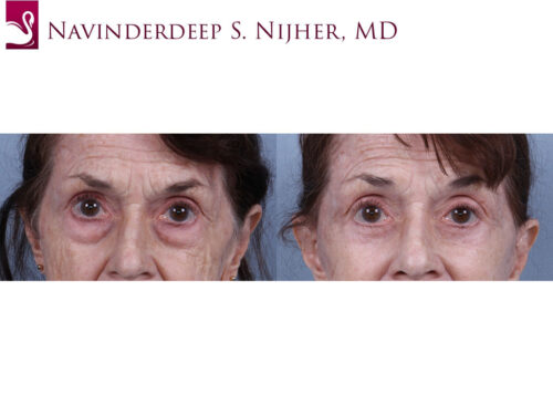 Eyelid Surgery Case #73993 (Image 1)
