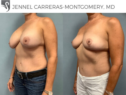 Breast Lift (Mastopexy) Case #39561 (Image 2)