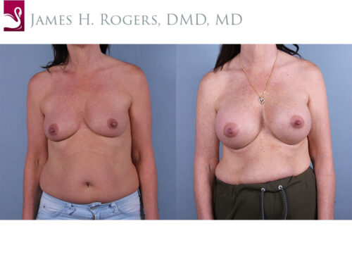 Breast Augmentation Case #74853 (Image 1)