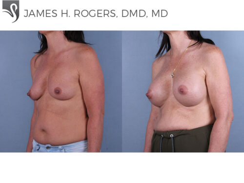 Breast Augmentation Case #74853 (Image 2)