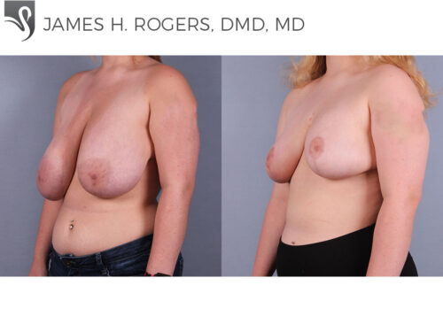 Female Breast Reduction Case #74910 (Image 2)