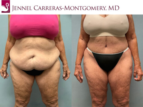 Post-Bariatric Surgery Case #74911 (Image 1)