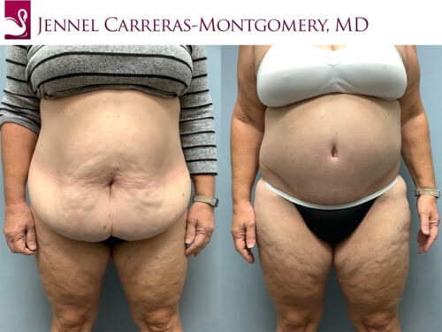 Post-Bariatric Surgery Case #75668 (Image 1)