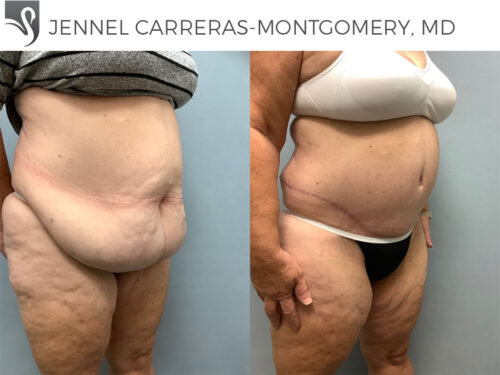 Post-Bariatric Surgery Case #75668 (Image 2)