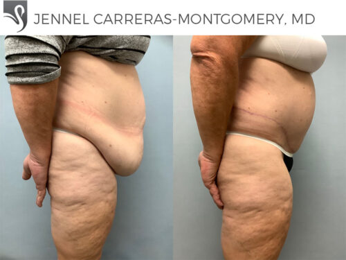 Post-Bariatric Surgery Case #75668 (Image 3)
