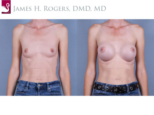 Breast Augmentation Case #76647 (Image 1)