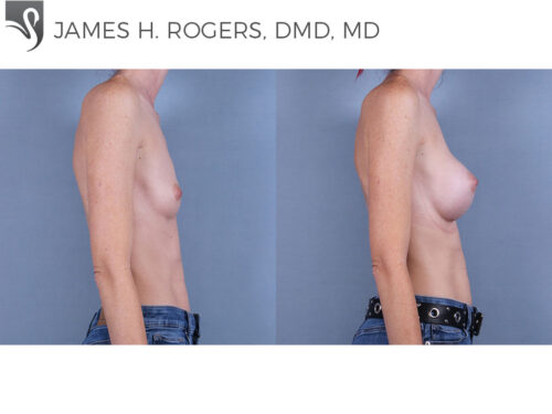 Breast Augmentation Case #76647 (Image 3)