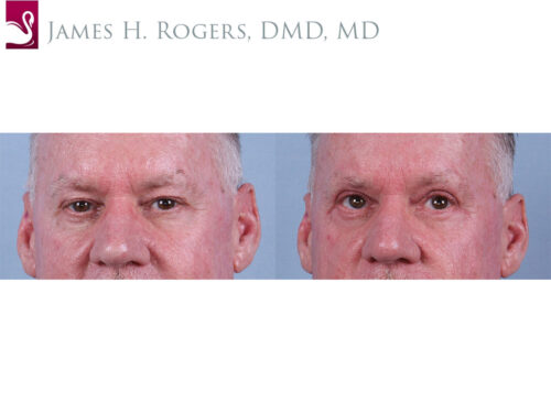 Eyelid Surgery Case #76949 (Image 1)