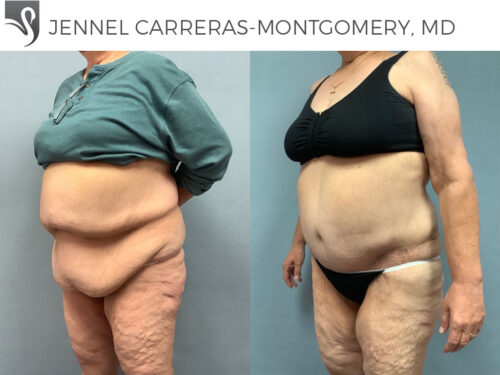 Post-Bariatric Surgery Case #65383 (Image 2)