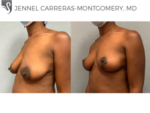 Breast Lift (Mastopexy) Case #71294 (Image 2)