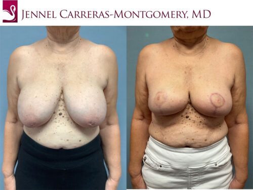 Breast Reconstruction Case #76302 (Image 1)