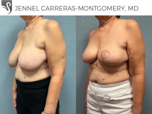 Breast Reconstruction Case #76302 (Image 2)