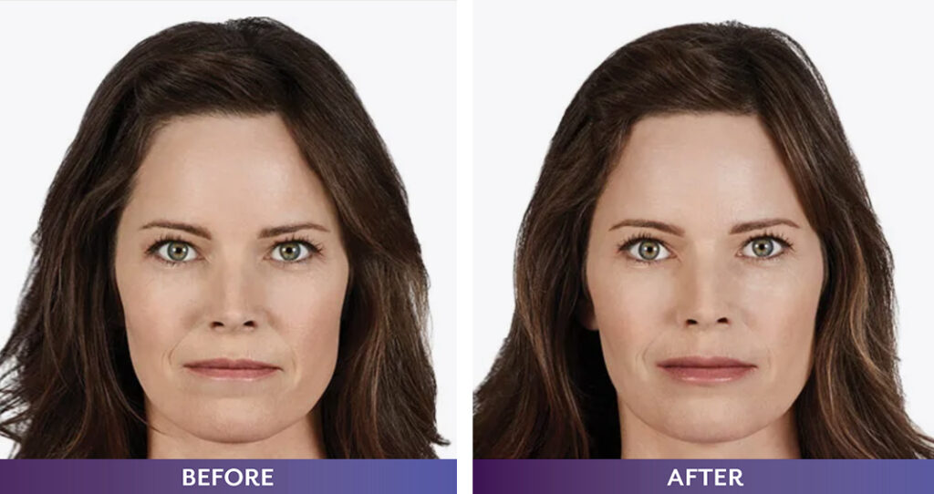 Juvederm Ultra XCBefore and after