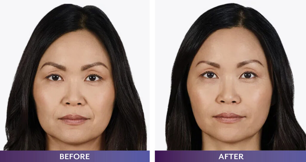 Juvederm Ultra Plus Before and after