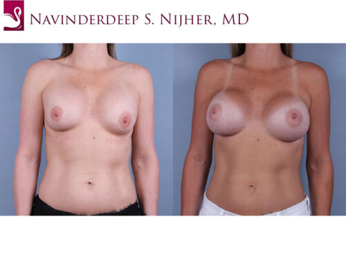 Breast Revisions Case #35715 (Image 1)