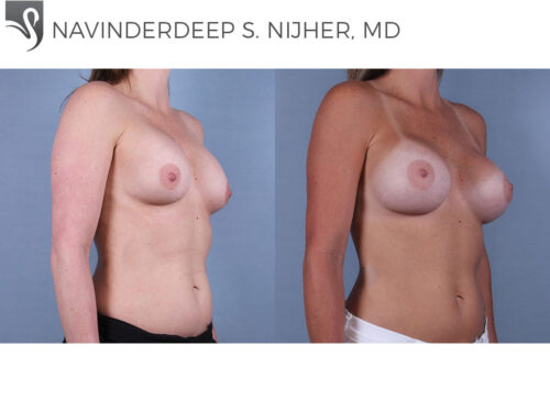 Breast Revisions Case #35715 (Image 2)