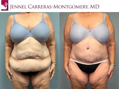 Post-Bariatric Surgery Case #76807 (Image 1)