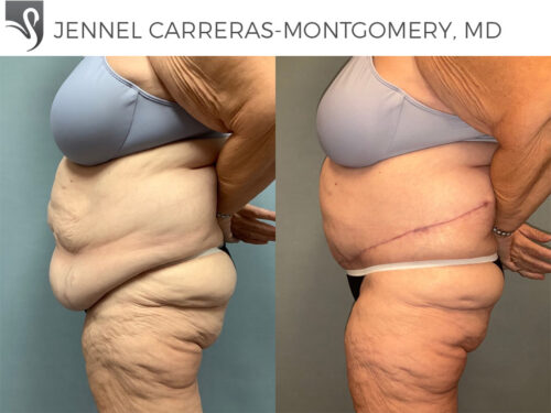 Post-Bariatric Surgery Case #76807 (Image 3)