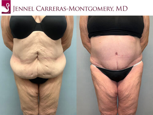 Post-Bariatric Surgery Case #77099 (Image 1)