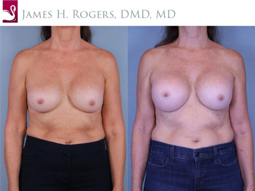 Breast Revisions Case #78339 (Image 1)