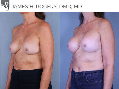 Breast Revisions Case #78339 (Image 2)