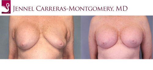 Breast Revisions Case #33475 (Image 1)