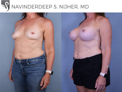 Breast Augmentation Case #44221 (Image 2)