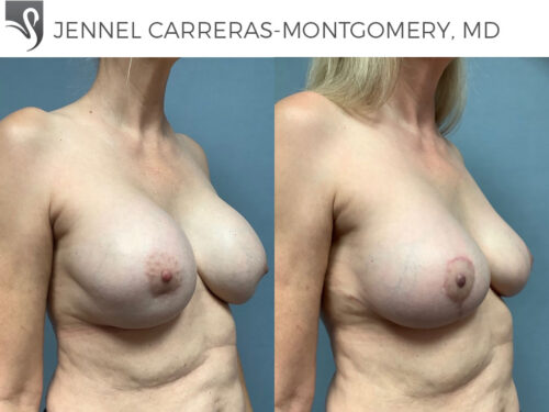Breast Revisions Case #75463 (Image 2)
