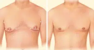 05 liposuction combo 01 02 05 liposuction combo 01 02