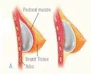 08 inserting 08 inserting