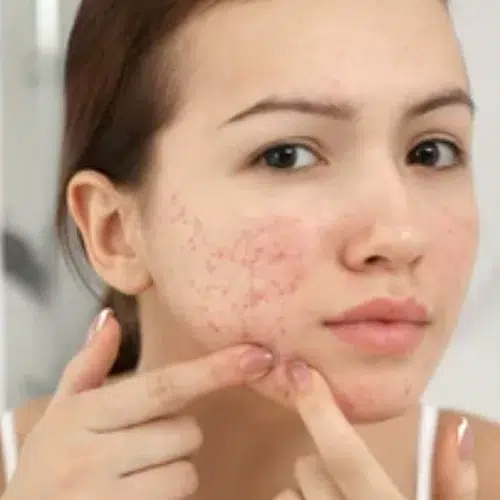 Dermatology Conditions acne.jpg