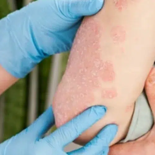 Dermatology Conditions eczema.jpg