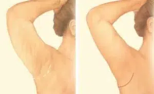 arm lift minimal incision arm lift minimal incision