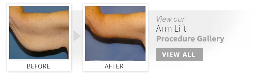 before after arm lift desktop