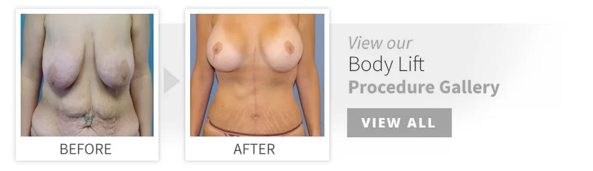 before after body lift desktop