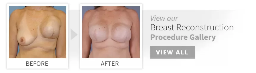 before after breast reconstruction desktop