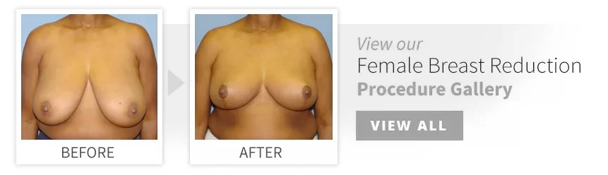 before after breast reduction desktop