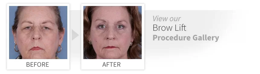 before after brow lift desktop