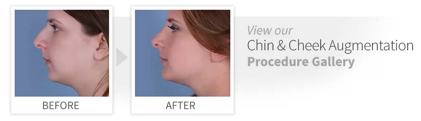 before after chin cheek augmentation desktop