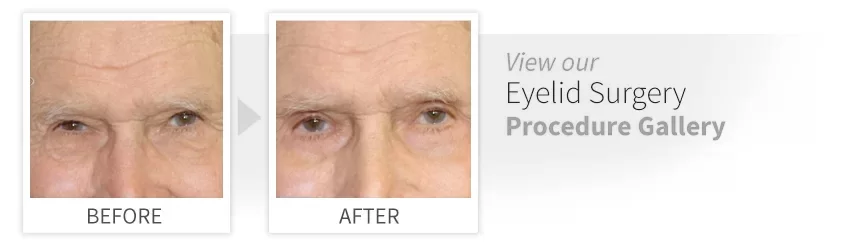 before after eyelid surgery desktop