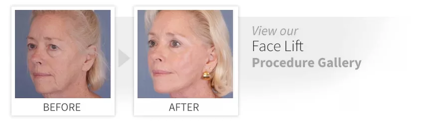 before after face lift desktop.jpg