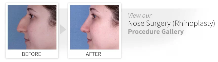 before after nose surgery desktop.jpg
