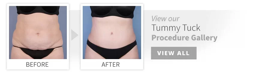 before after tummy tuck desktop