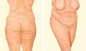 body lifit incision body lifit incision