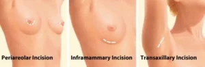 breast augmentation incisions breast augmentation incisions