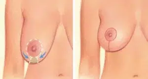 breast lift incision areola breast crease breast lift incision areola breast crease